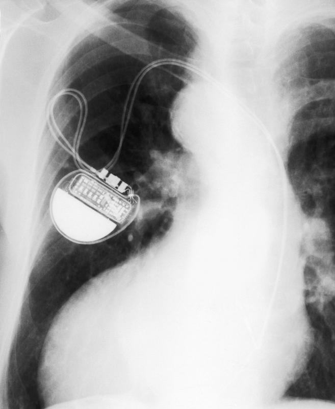 A pacemaker inside a patient.