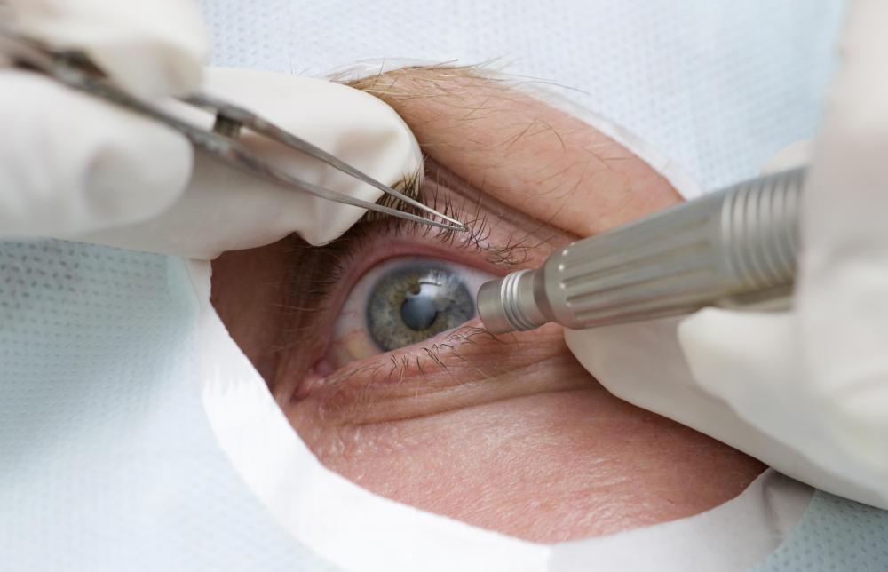 A canthoplasty may give the eyes a cat-like appearance.