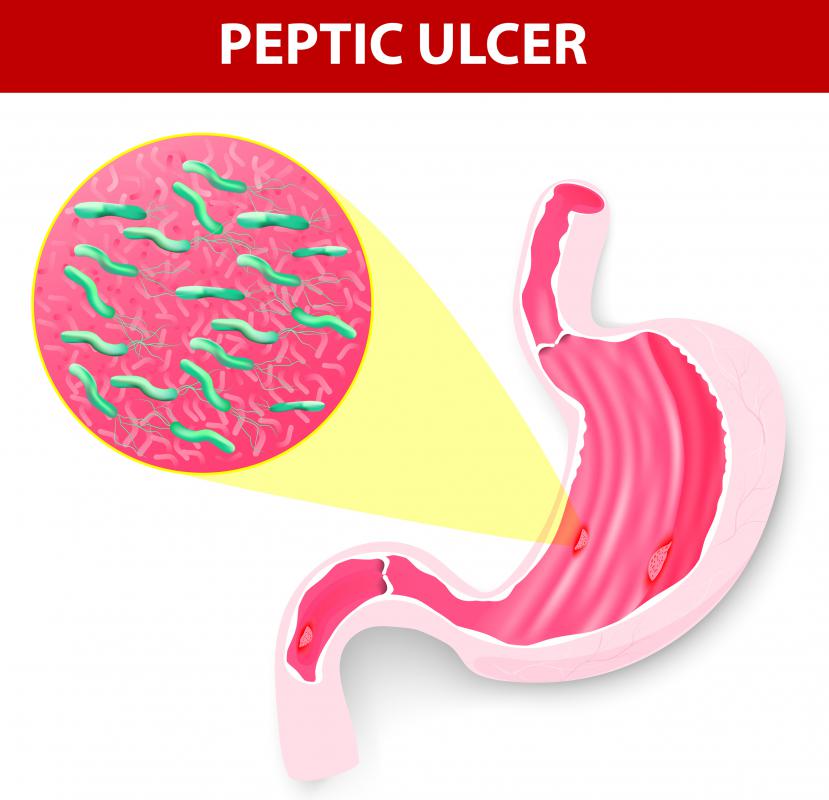 Elevated levels of pancreatic lipase may occur as a side effect of a peptic ulcer.
