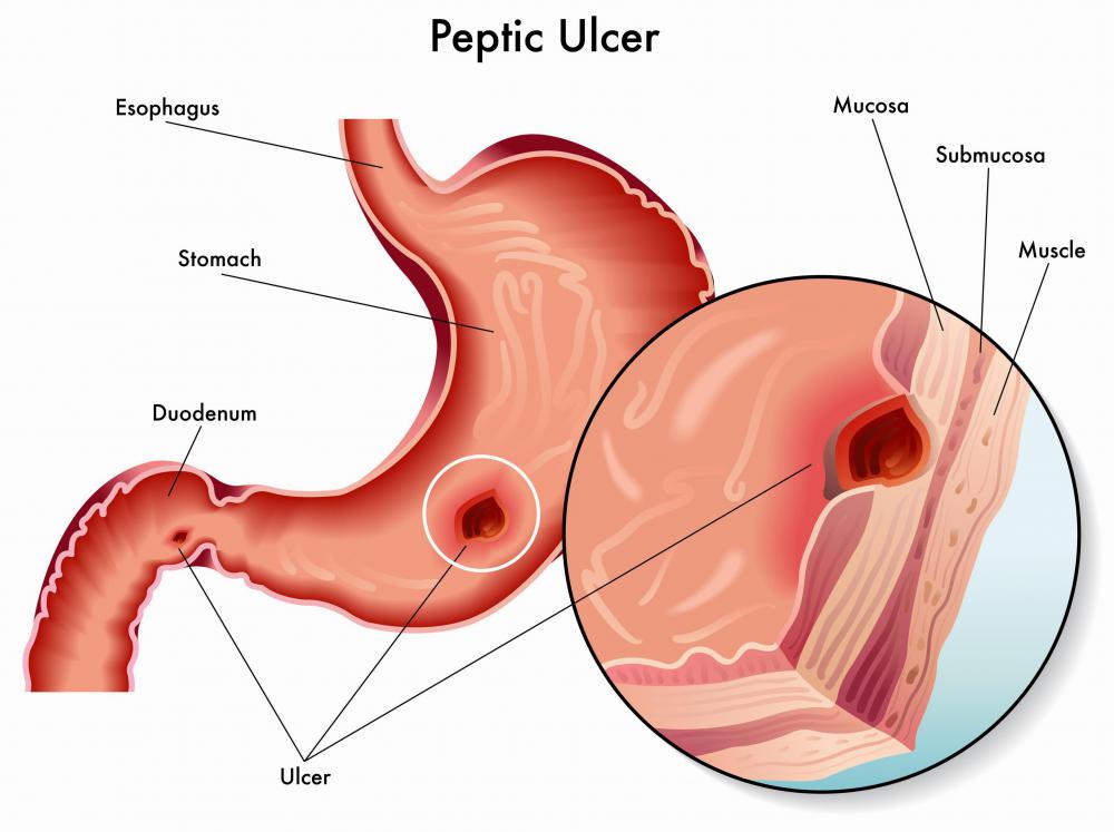 Omeprazole, designed to reduce stomach discomfort from ulcers, may make a patient more likely to eat.