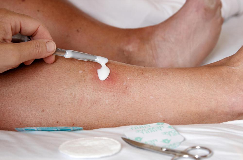 Scabs sometimes turn white if they have been coated in thick ointment for too long.