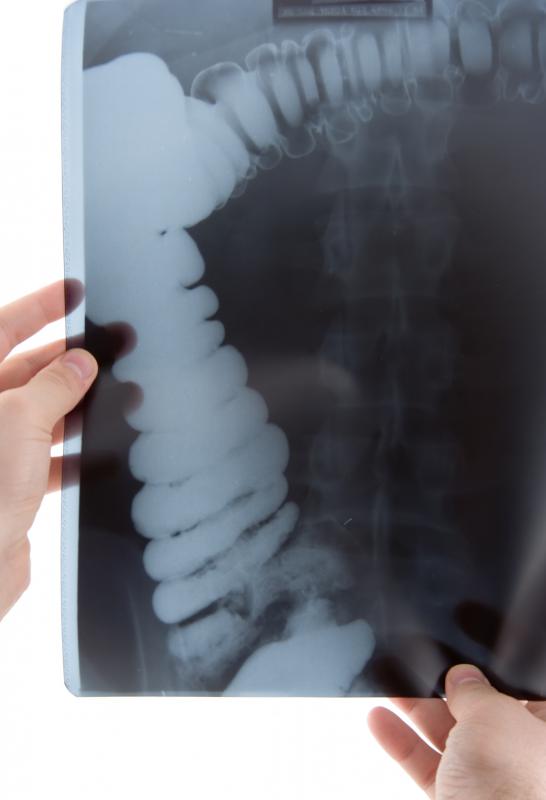 A patient suffering from ulcerative colitis may require an ileostomy.