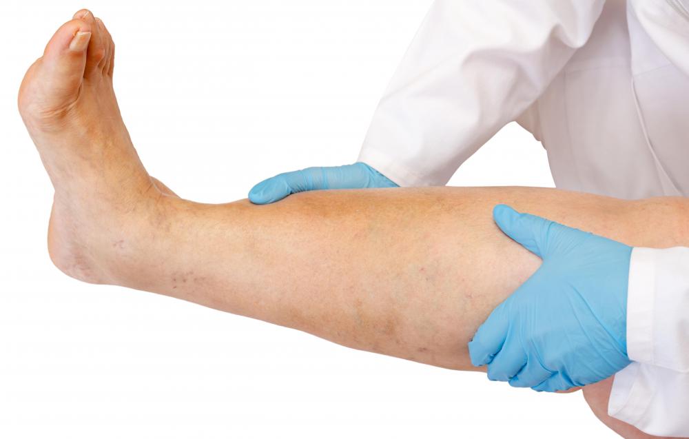 An arteriovenous shunt may cause swelling in the legs.