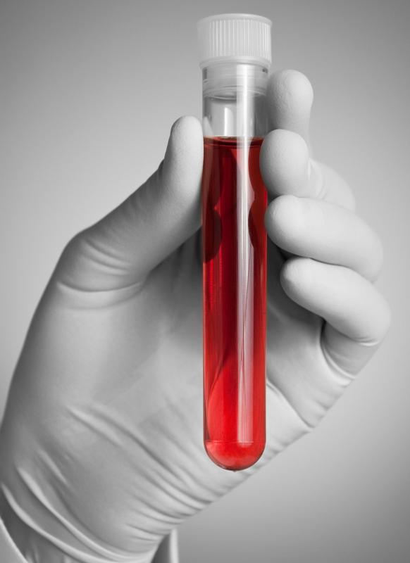 Blood tests may be used to diagnose dwarfism.
