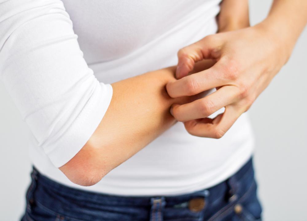 Hives are commonly associated with itchiness.