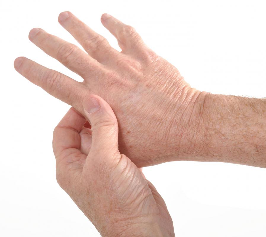 Rheumatoid arthritis is an immune disorder that commonly affects the hands and wrists.