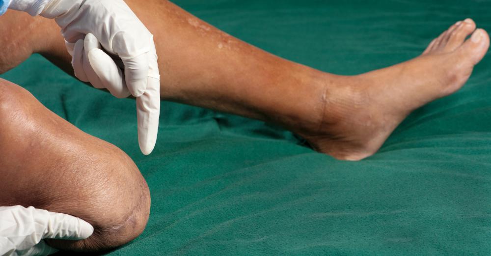 Amputations, which may be used to treat the most serious wounds, are when a limb is detached from the body.