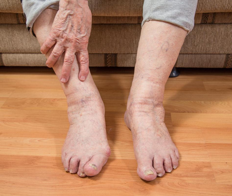 Toe pain may occur as a result of arthritis.