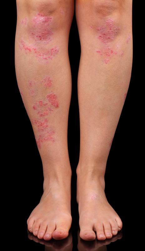 Inositol nicotinate is sometimes used to treat psoriasis.