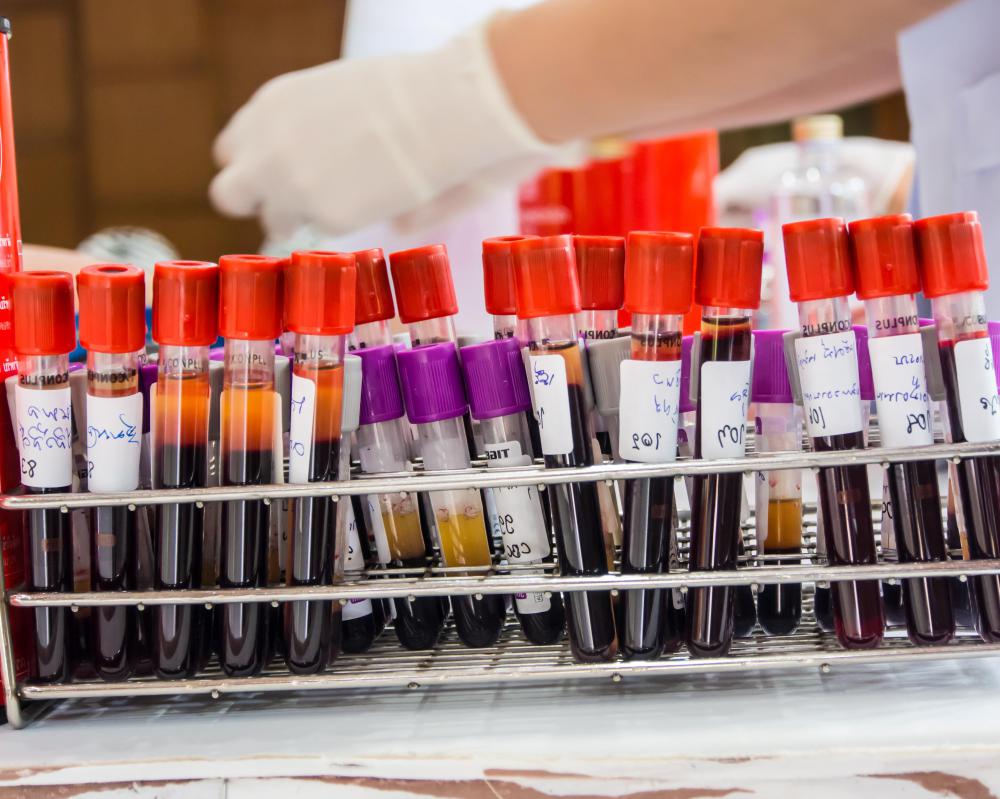 Doctors may collect blood samples from multiple individuals in a given area in order to determine the scope of a disease outbreak.