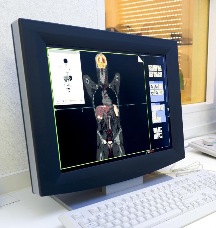 PET scans show the areas of the body containing the most cellular activity, including cancer cells.