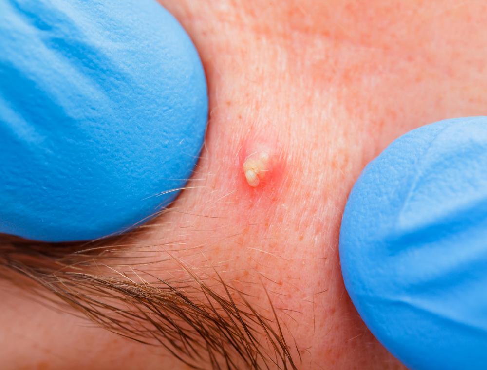 Pimple pus should be washed and cleaned with an antiseptic.