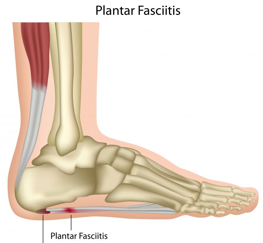 Plantar fasciitis, which is the inflammation of the tissues that link the toes to the heel, is a common foot problem.