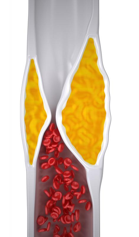 Reversible ischemia may be caused by plaque buildup in the arteries.