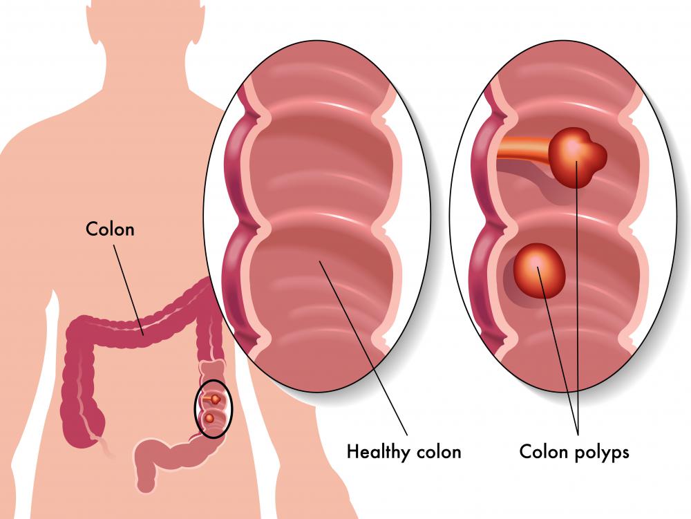 Lesions in the colon can take the form of polyps.