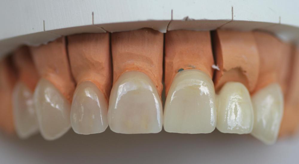 Veneers can cover the entire surface of a tooth a completely change a person's smile.