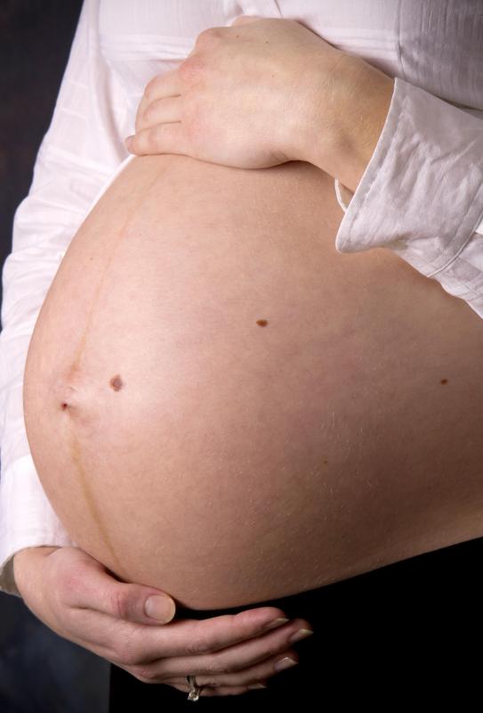 Some women may develop varicose veins during pregnancy.