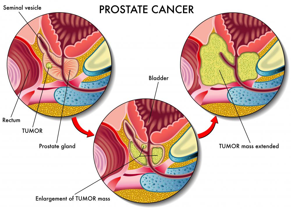 A failure of cell death connected to IGF-1 may cause prostate cancer.