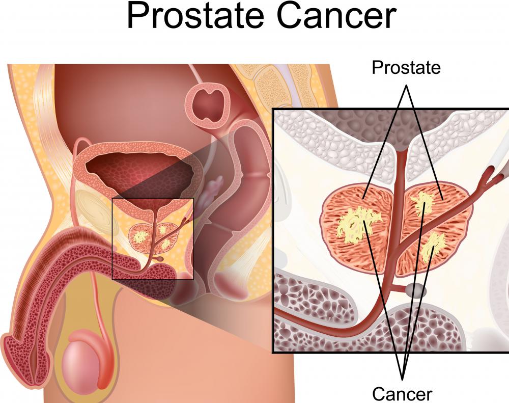There is some evidence suggesting that gamma-linolenic acid increases one's risk of prostate cancer.