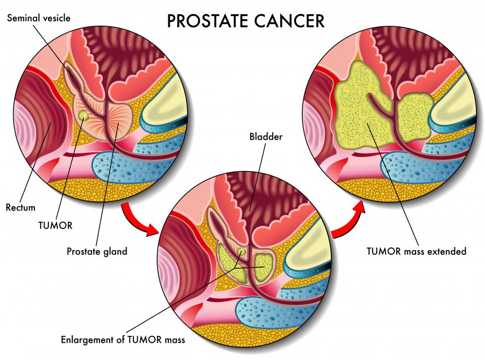 An orchiectomy may improve the survival rate of patients suffering from prostate cancer.