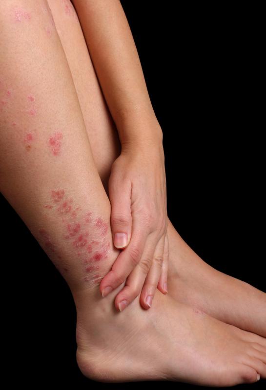 Scurvy can cause dry skin and hair.