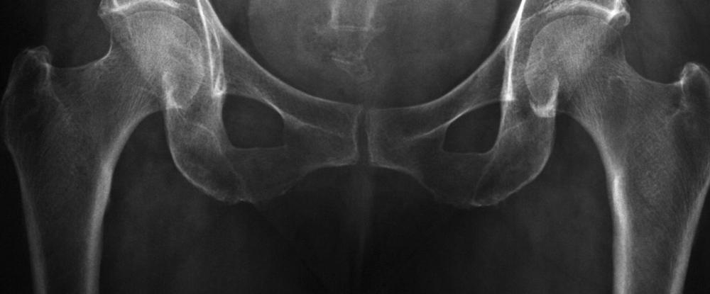 The symphysis pubis is an immovable joint.