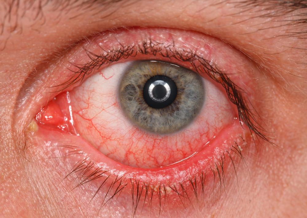 Eye drops may cause eye redness.