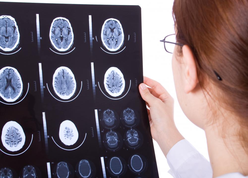 A brain injury may cause an individual to lose the ability of thinking in abstract terms.