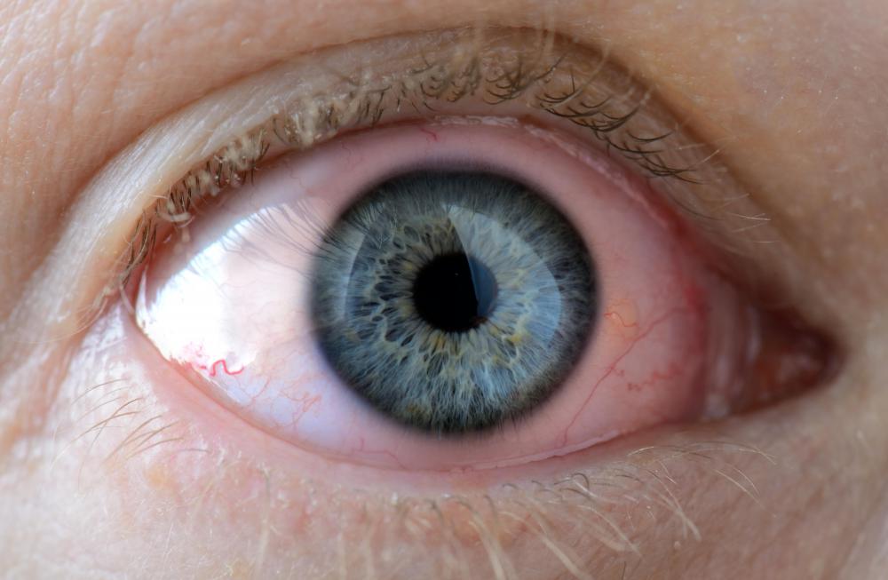 Handling fiberglass insulation may cause eye irritation.