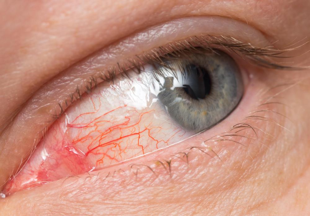 Bacitracin may be used to treat eye infections.