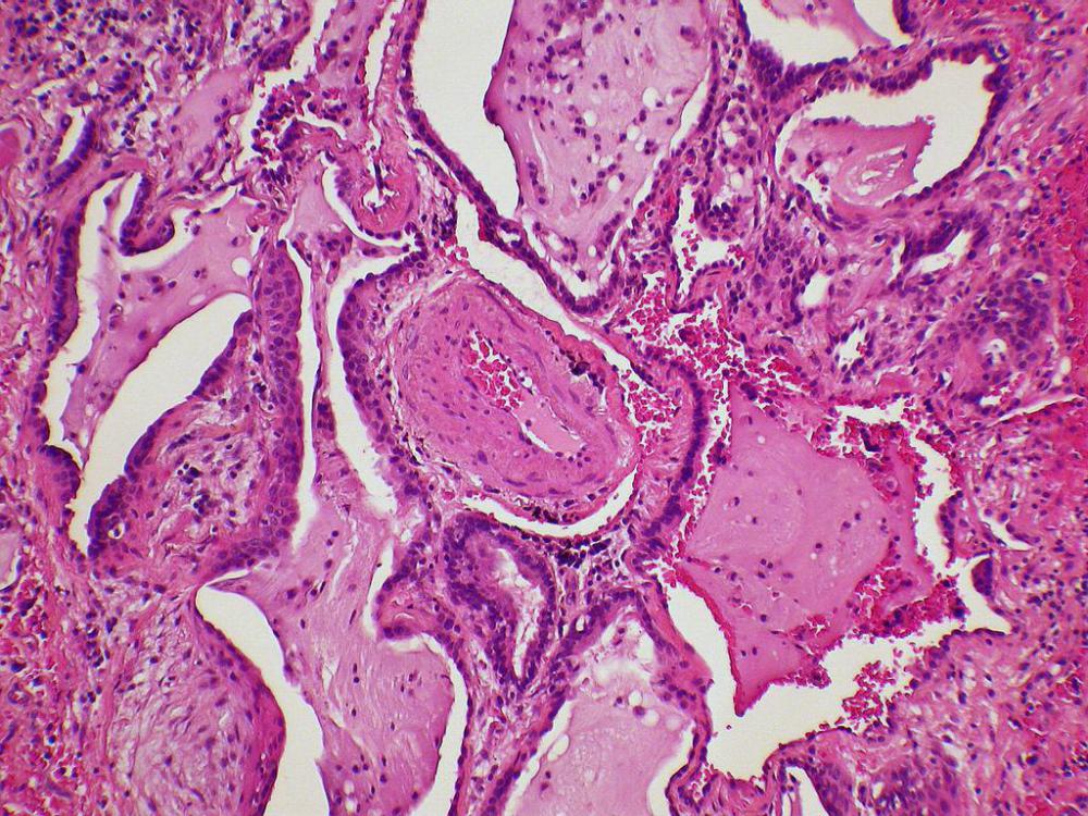 Respiratory epithelial tissue can be separated by bands of inflamed tissue and muscle.