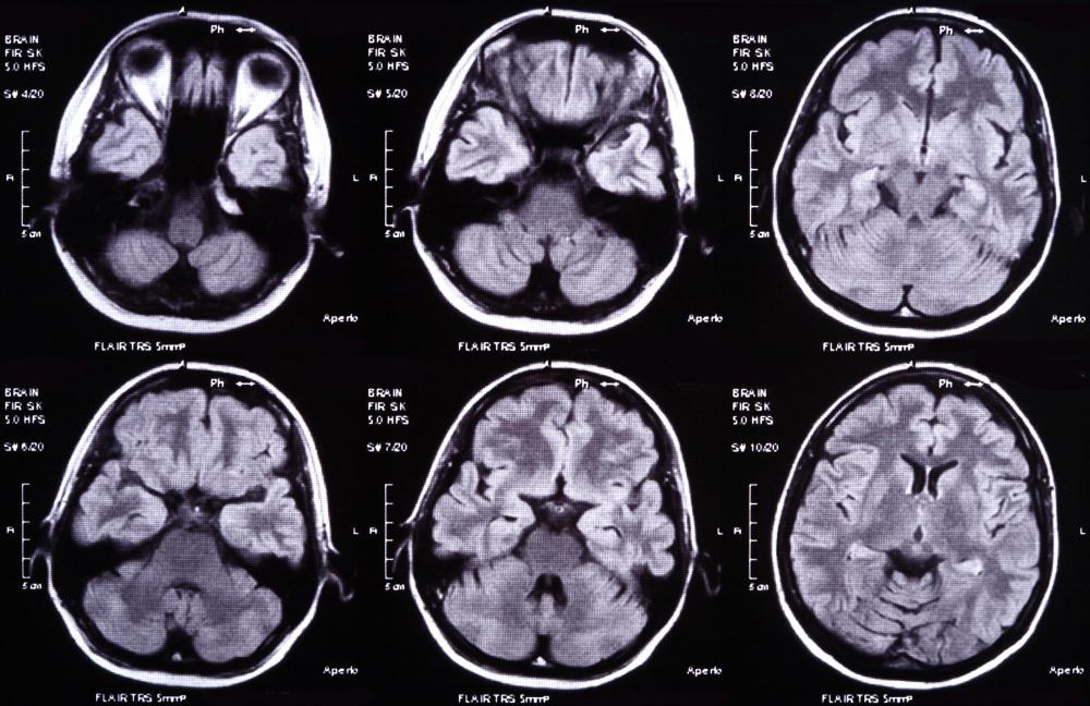 Brain scans are used to observe the reticular activating system's role during sleep and dreaming.