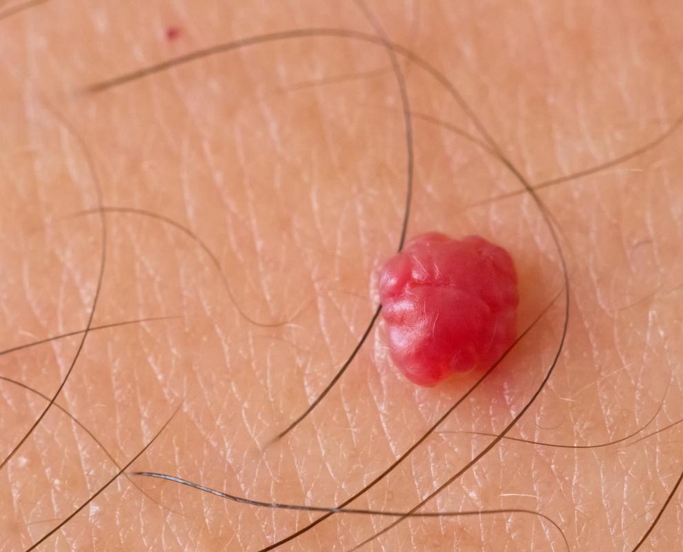 Cherry angiomas pose no health risk, but are often removed for cosmetic reasons.