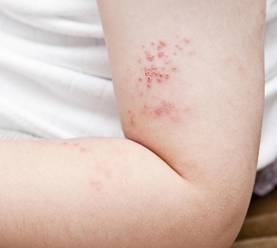 Skin affected by shingles is more prone to infection.
