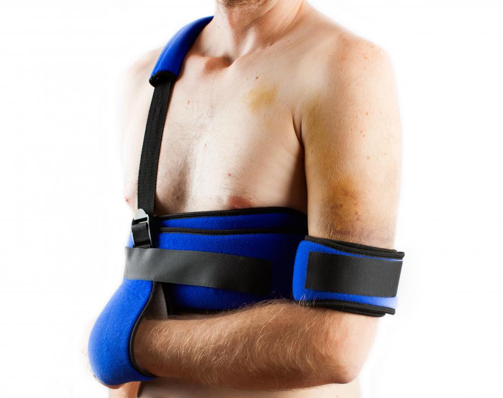 After the mumford procedure, the arm is immobilized in a sling as part of the recovery.