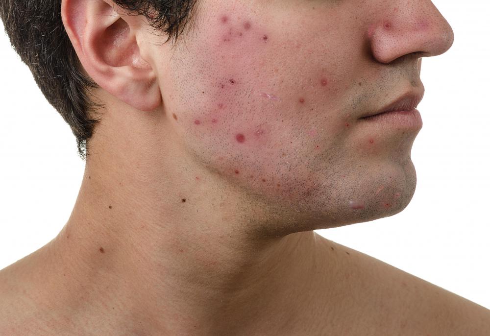 Doxycycline monohydrate may be used to treat acne.