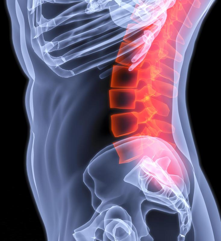 Dural ectasia affects the dura in the lower spine.