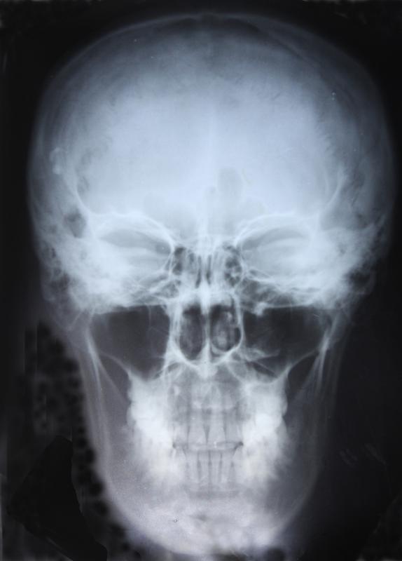A radiograph can show the frontal sinuses in the forehead.