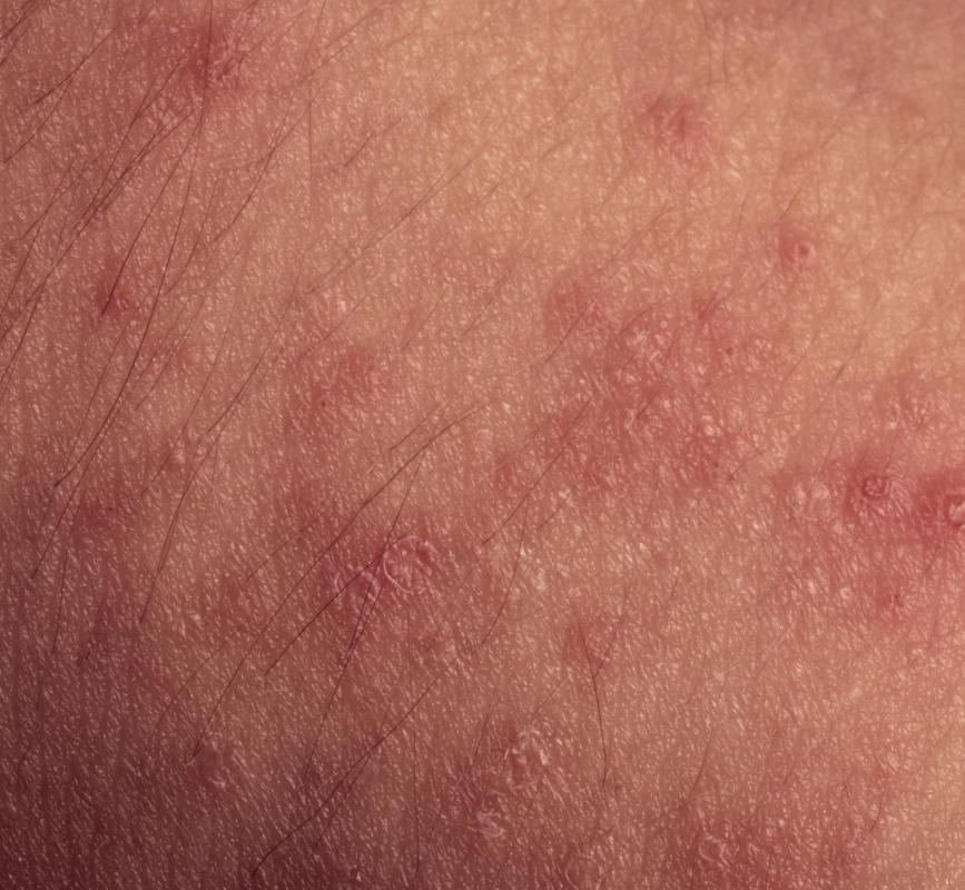 Formaldehyde has been linked with the development of skin rashes on some people.