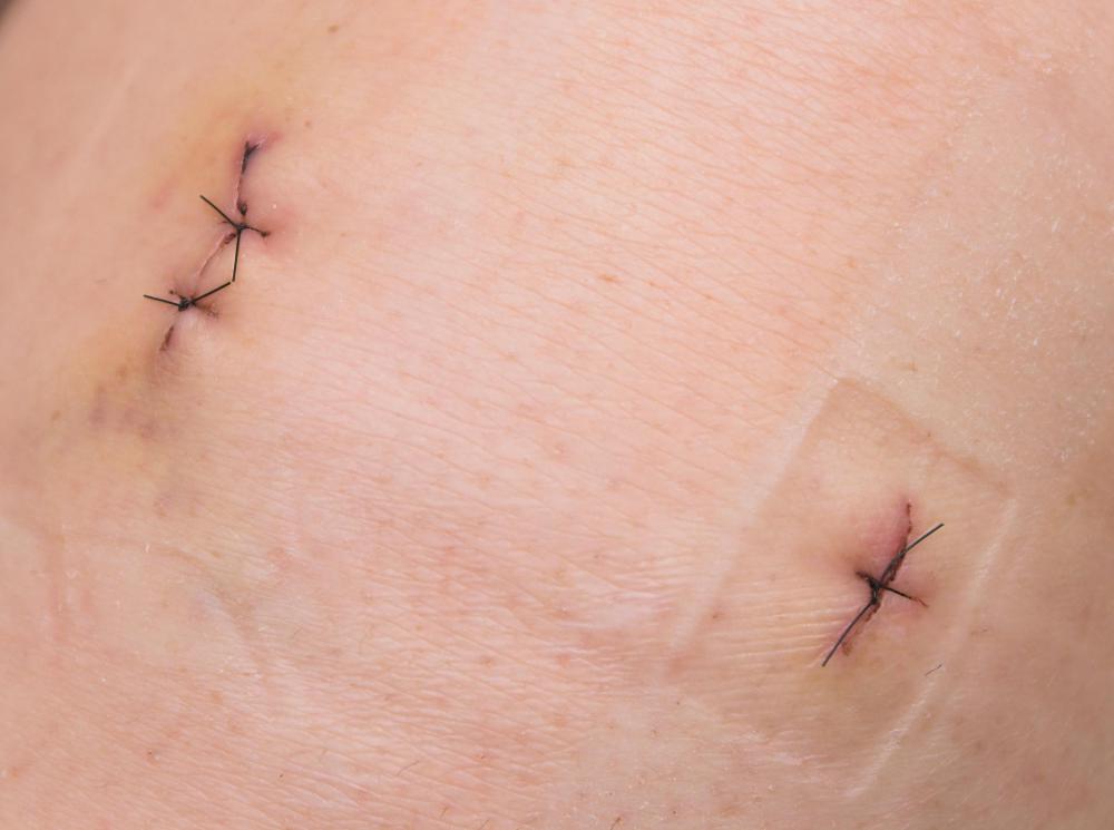In the medical field, curved scissors may be used for removing stitches.