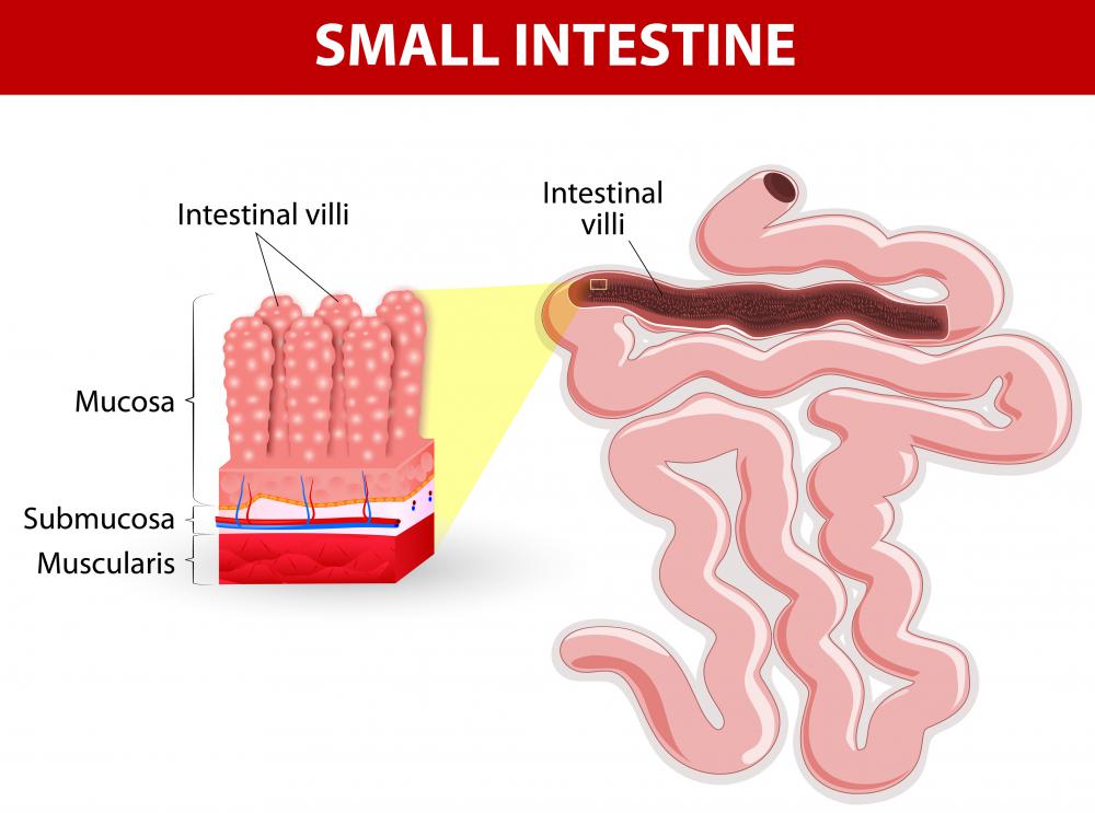 Crohn's disease causes inflammation of the lining and wall of the large and/or small intestine.