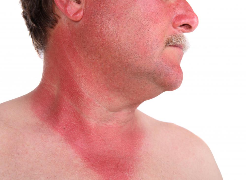 Sunburn makes skin red and painful.