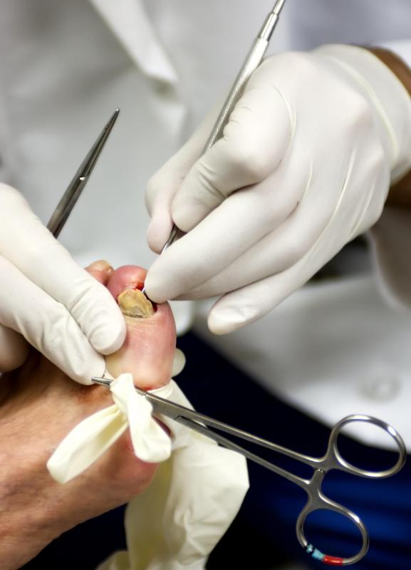 Unchecked fungal toenail infections may lead to onychodystrophy.