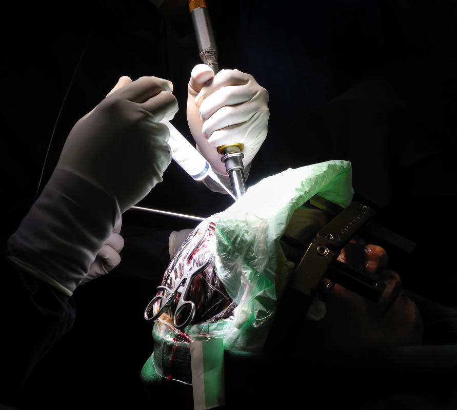 Most of the time, a brain stem infarct will require surgery.