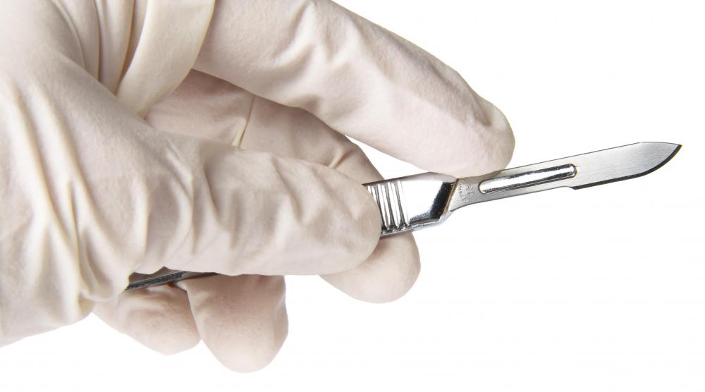 A scalpel may be used to remove oral warts.