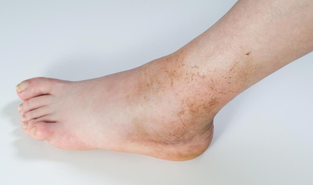 Osteomyelitis may cause swelling of the ankles and feet.