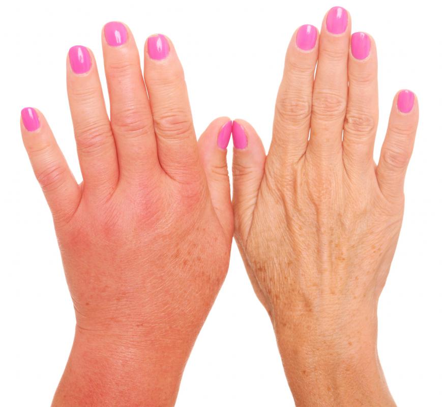 Swollen hands may be a sign of glomerular disease.
