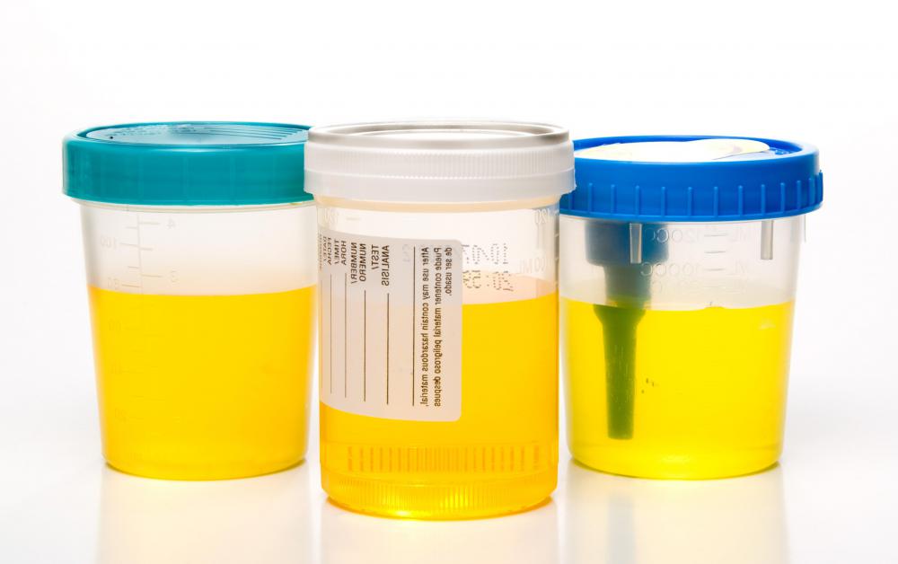 Doctors may require urine samples to diagnose ornithine transcarbamylase deficiency.