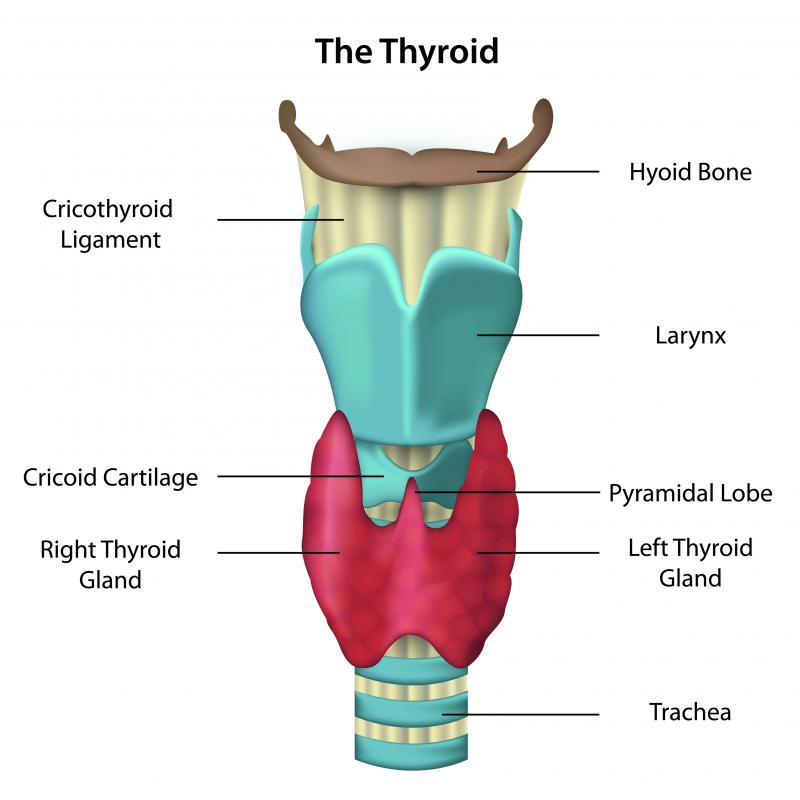 Thyroid calcification is a solid or semi-solid lump within the thyroid gland.