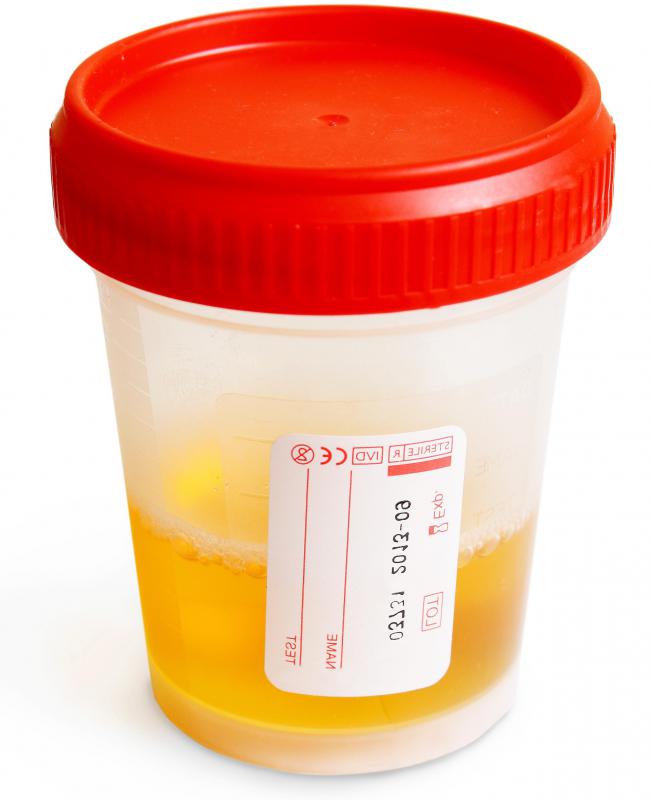 A urine sample might be used for an ELISA test.